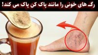 درمان های خانگی واریس